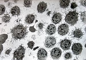 F,59y. | blood - hairy cell leukemia F,59y. | blood - hairy cell leukemia